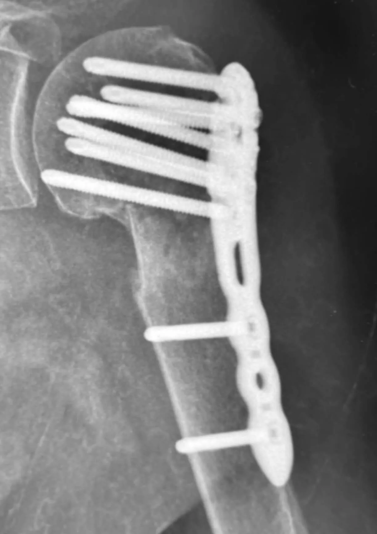 4 miesiące po operacji