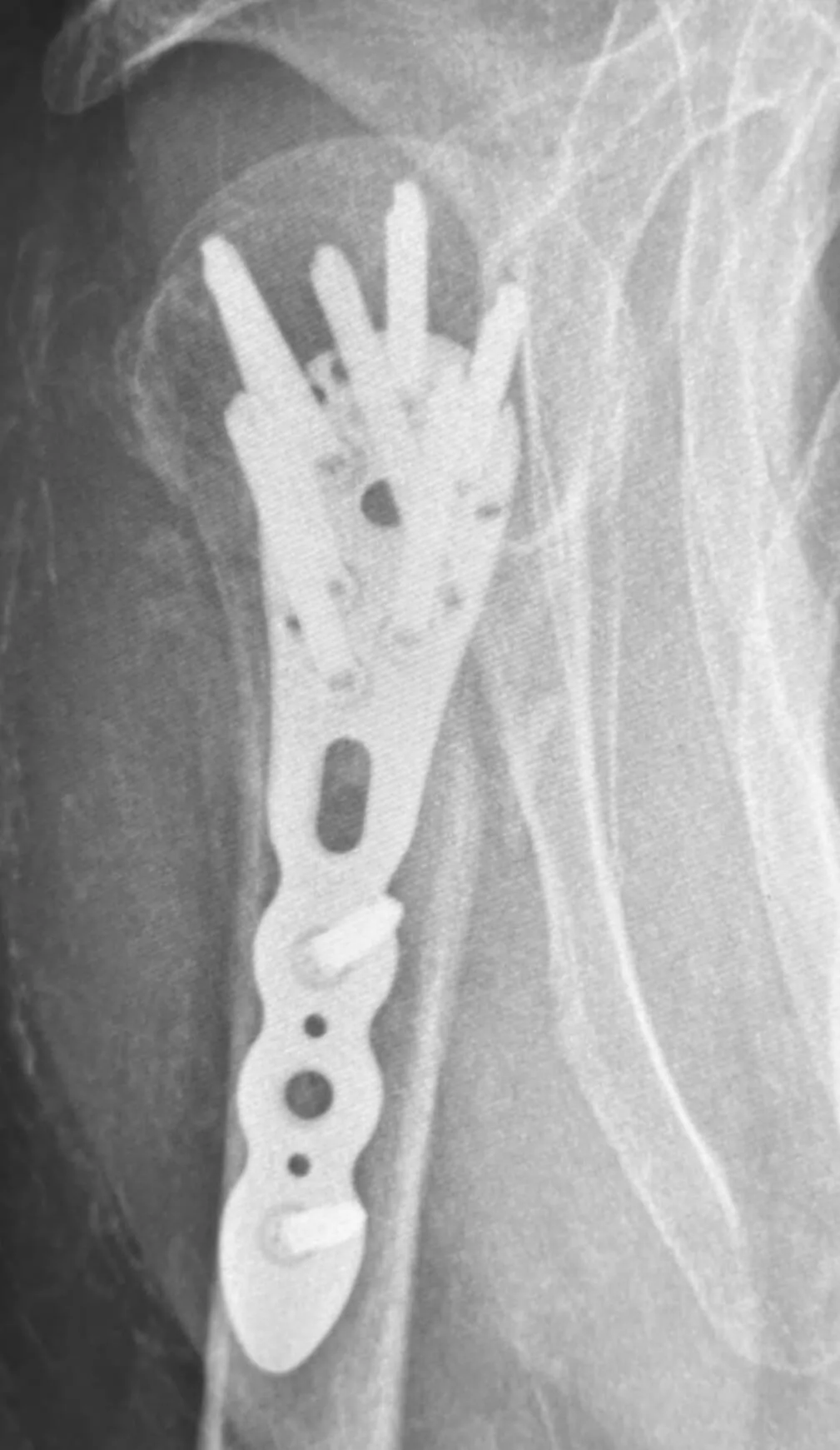 4 miesiące po operacji